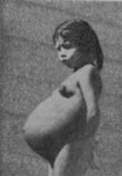 Lina Medina sinh năm 1939 ở Ticrapo, Peru. Khi được 5 tuổi, bố mẹ Lina đã đưa cô bé đến bệnh viện kiểm tra vì phát hiện bụng con phát triển ngày càng to. Ba mẹ cô lo nghĩ đó có thể là khối u ở bụng nhưng sau khi các bác sĩ kiểm tra, họ xác định Lina đang mang thai ở tháng thứ 7.